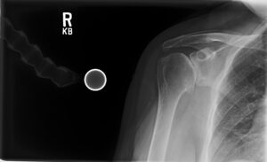 Exray showing bone to bone shoulder joint with bone spur.